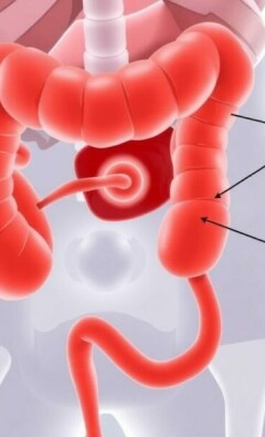 Differenzialdiagnosen der Blinddarmentzündung: Wenn der Bauch schmerzt, aber es nicht der Blinddarm ist