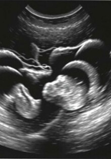 Die Sonographie-Befunde bei Appendizitis: entendiendo la «Kokarde» y el «target sign» para diagnosticar con más confianza