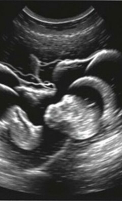 Die Sonographie-Befunde bei Appendizitis: entendiendo la «Kokarde» y el «target sign» para diagnosticar con más confianza