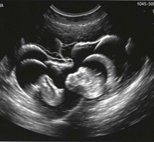 Die Sonographie-Befunde bei Appendizitis: entendiendo la «Kokarde» y el «target sign» para diagnosticar con más confianza