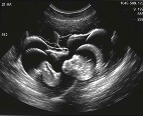 Die Sonographie-Befunde bei Appendizitis: entendiendo la «Kokarde» y el «target sign» para diagnosticar con más confianza