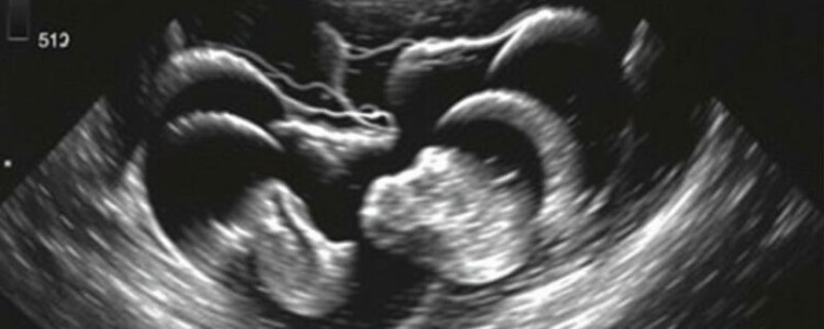 Die Sonographie-Befunde bei Appendizitis: entendiendo la «Kokarde» y el «target sign» para diagnosticar con más confianza