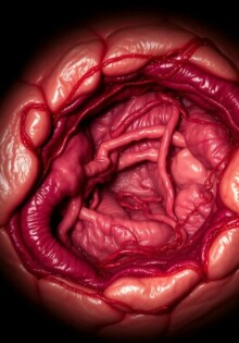 Subphrenischer Abszess: el enemigo silencioso bajo el diafragma