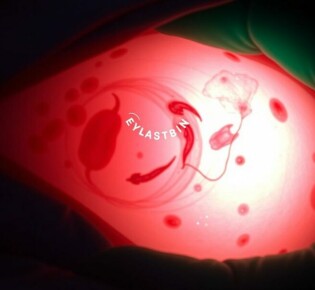 Infecciones postoperatorias tras una apendicectomía: qué son, por qué ocurren y cómo evitarlas