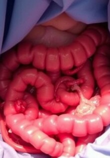 Apendicitis como hallazgo incidental durante otra operación: comprender, decidir y comunicar