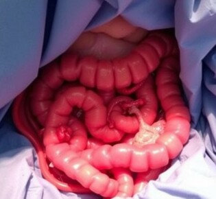 Apendicitis como hallazgo incidental durante otra operación: comprender, decidir y comunicar