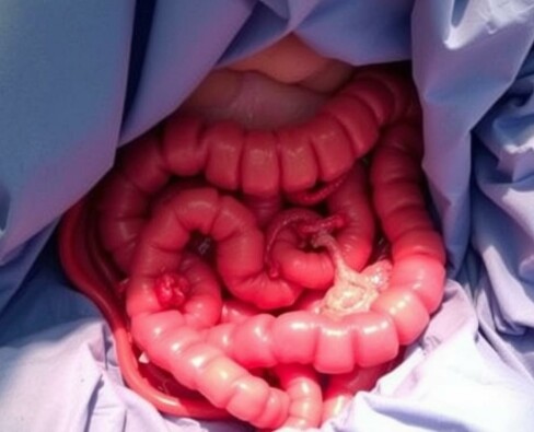 Apendicitis como hallazgo incidental durante otra operación: comprender, decidir y comunicar