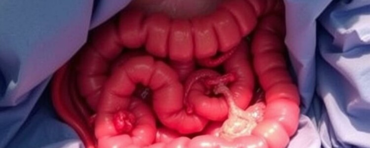 Apendicitis como hallazgo incidental durante otra operación: comprender, decidir y comunicar