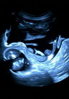 Radiación en niños: ¿Por qué elegir primero el ultrasonido antes que la tomografía computarizada? (Strahlenexposition bei Kindern: Ultraschall vor CT)