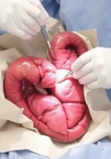 Preparación preoperatoria para una apendicectomía: guía práctica y tranquila para pacientes y familiares