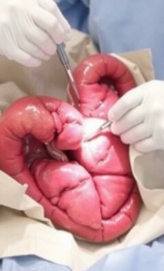 Preparación preoperatoria para una apendicectomía: guía práctica y tranquila para pacientes y familiares