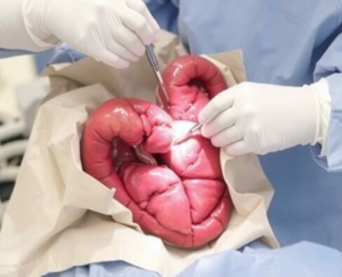 Preparación preoperatoria para una apendicectomía: guía práctica y tranquila para pacientes y familiares