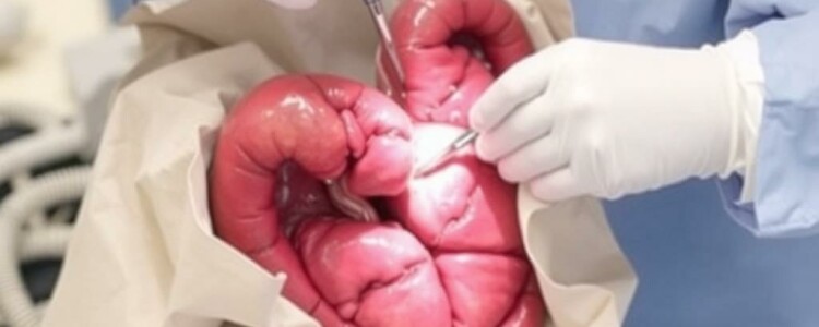 Preparación preoperatoria para una apendicectomía: guía práctica y tranquila para pacientes y familiares