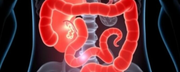 Apendicitis y gastroenteritis: cómo diferenciarlas