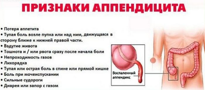 признаки аппендицита