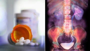 Антибиотики могут повысить риск развития камней в почках: исследования