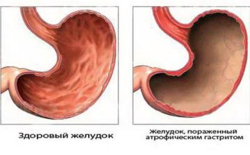 Атрофический гастрит: причины, симптомы, лечение, диагностика
