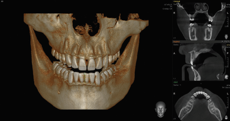 Как проводится 3D-томография челюстно-лицевой области?