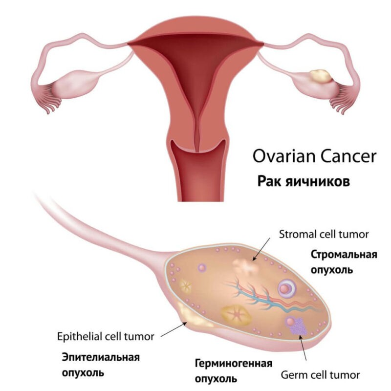 Лечение рака яичников OncoCareClinic