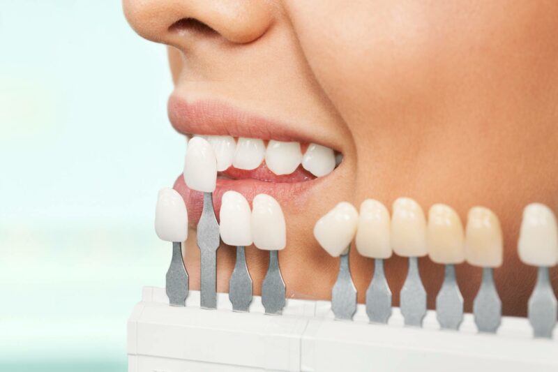 Стоматология «Reunion»: лечение зубов и установка виниров