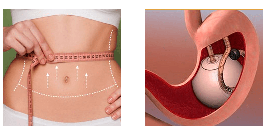 Выбор между резекцией и шунтированием желудка: Какая процедура подходит лучше для вас?