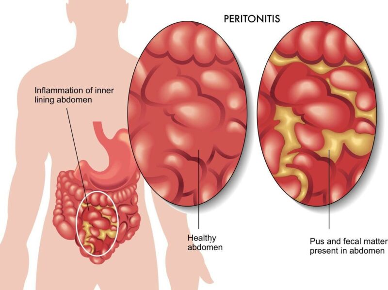 Аппендицит с перитонитом: опасный воспалительный процесс
