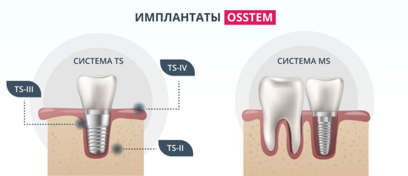 Почему поставить имплантат Osstem — лучшее решение для восстановления зубов?