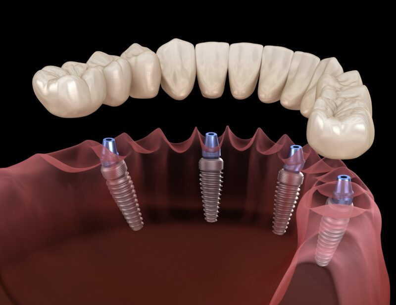 Результаты и ожидания после имплантации зубов на 4 имплантах
