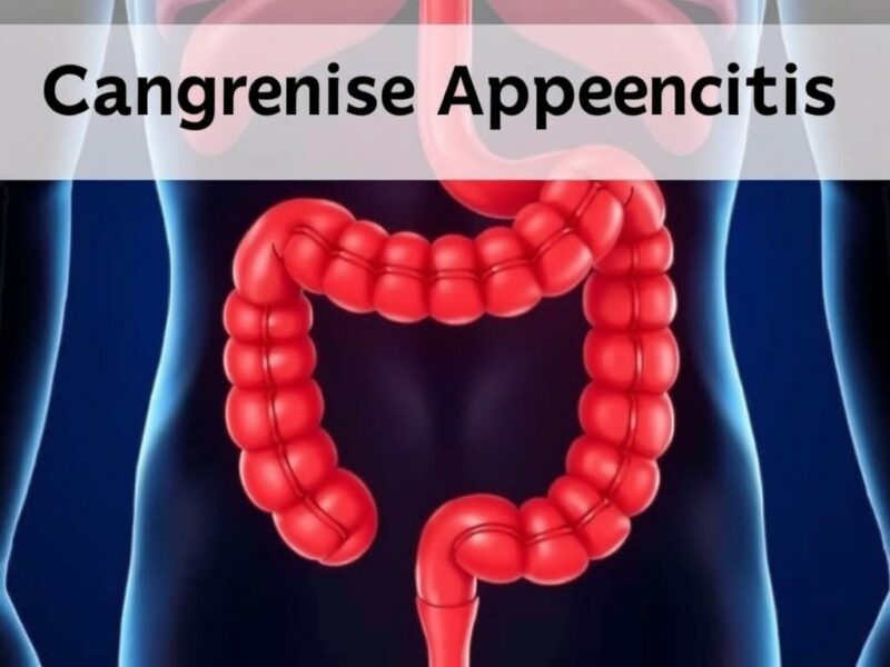  Appendicite Gangréneuse : Dangers et Traitements. Symptômes et diagnostic de l’appendicite gangréneuse