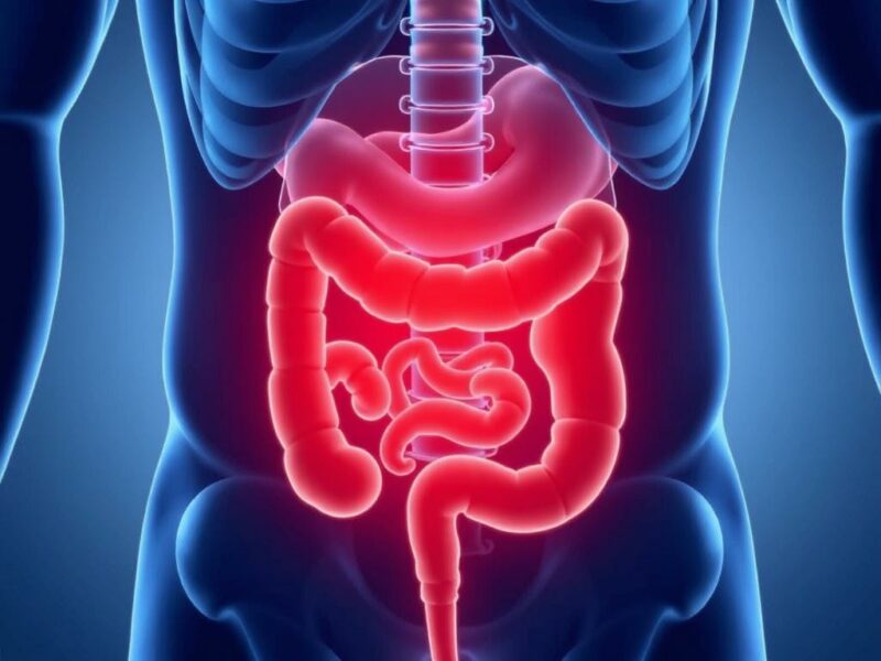  Can Stress Cause Appendicitis?. What is Appendicitis?