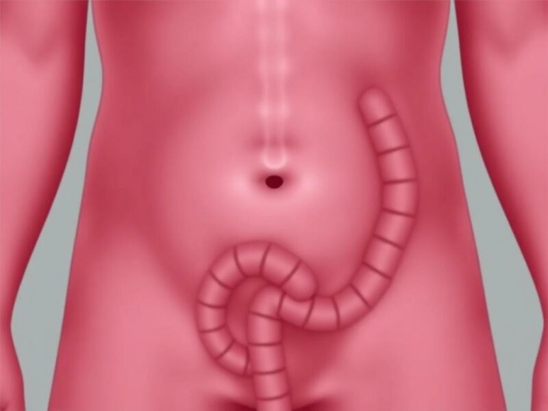  Thromboseprophylaxe nach Blinddarm-OP. Besonderheiten und Empfehlungen für Diagnostik und Nachsorge