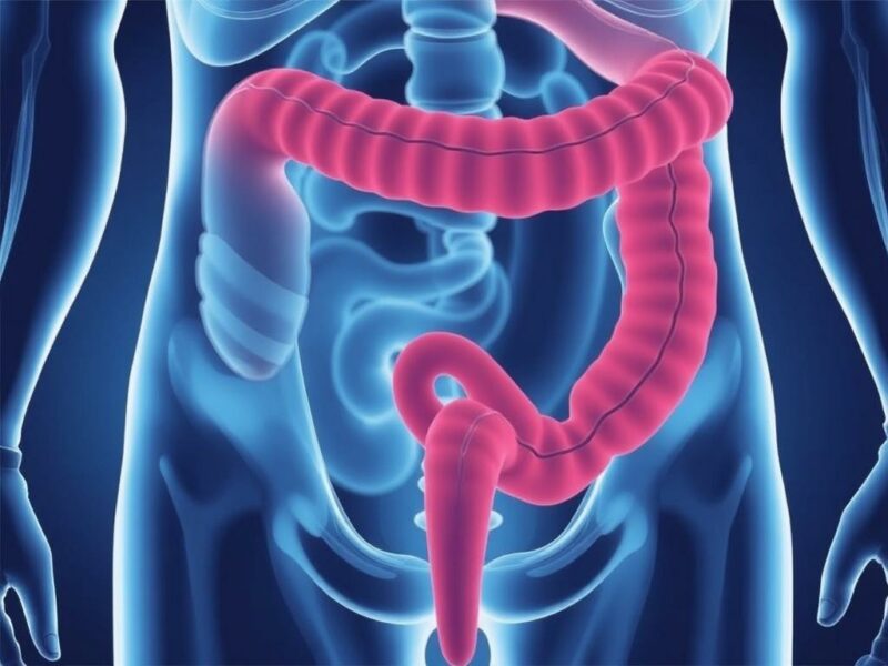 Appendicitis and Bowel Obstruction. Complications to Watch For Appendicitis and Bowel Obstruction. Complications to Watch For