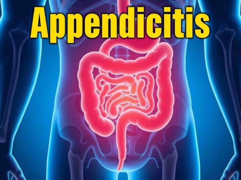  Appendicite : Peut-on en Mourir ?. Qu’est-ce que l’appendicite ?