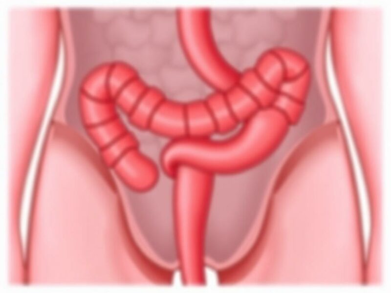  Notfall-OP bei Appendizitis: Wann ist sie notwendig?. Einleitung: Die dringende Frage der Appendizitis
