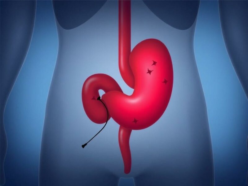  Appendicite Gangréneuse : Dangers et Traitements. Comparaison des formes d’appendicite