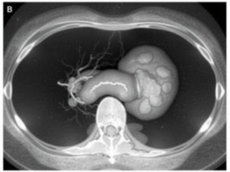  Rovsing’s Sign in Appendicitis. Interpreting Rovsing’s Sign: Limitations and Diagnostic Accuracy