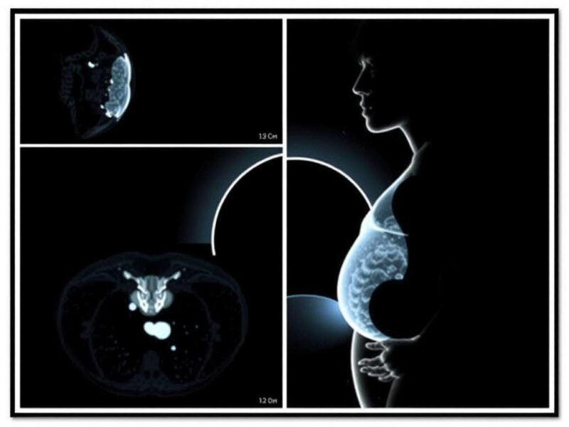 L'IRM : une alternative sans radiation pour les femmes enceintes.. Casos prácticos: ejemplos donde la RM cambió decisiones clínicas
