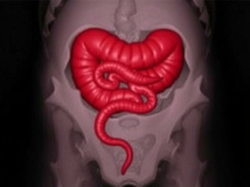 Les appendicites d'origine parasitaires (ex: oxyures).. ¿Qué significa exactamente "apendicitis de origen parasitario"?