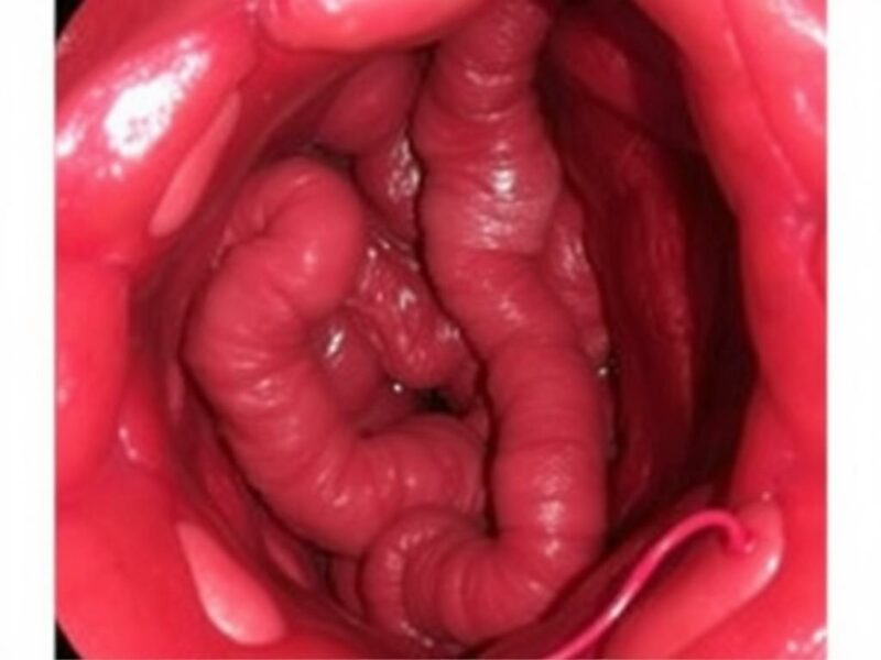 Natural Orifice Transluminal Endoscopic Surgery (NOTES) for Appendectomy.. Historia breve y evolución técnica Natural Orifice Transluminal Endoscopic Surgery (NOTES) for Appendectomy.. Historia breve y evolución técnica