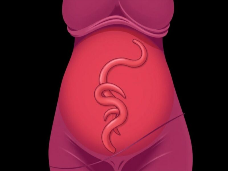 Maternal and Fetal Outcomes After Appendicitis in Pregnancy.. Cuidados obstétricos y seguimiento fetal Maternal and Fetal Outcomes After Appendicitis in Pregnancy.. Cuidados obstétricos y seguimiento fetal