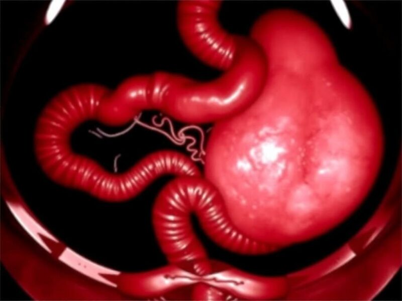 Appendizitis bei Kindern: Besonderheiten im Wachstumsalter. Diagnóstico: evaluación clínica y pruebas complementarias