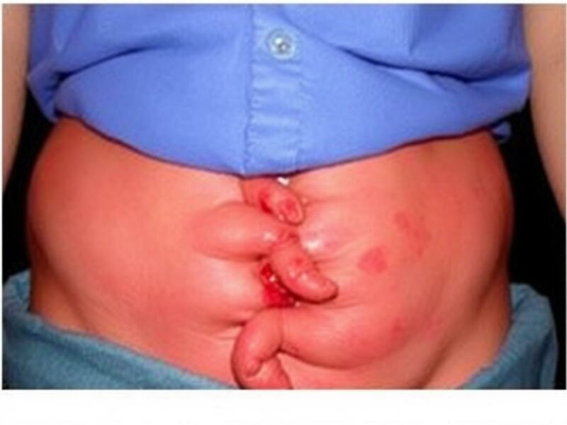 Intra-Abdominal Abscess Formation After Appendectomy.. Pronóstico y complicaciones asociadas Intra-Abdominal Abscess Formation After Appendectomy.. Pronóstico y complicaciones asociadas