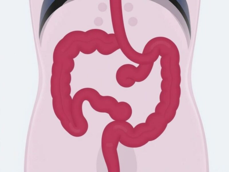 Der Umgang mit einer bereits perforierten Appendizitis. Cuidados en la unidad de cuidados intensivos y manejo de la sepsis Der Umgang mit einer bereits perforierten Appendizitis. Cuidados en la unidad de cuidados intensivos y manejo de la sepsis