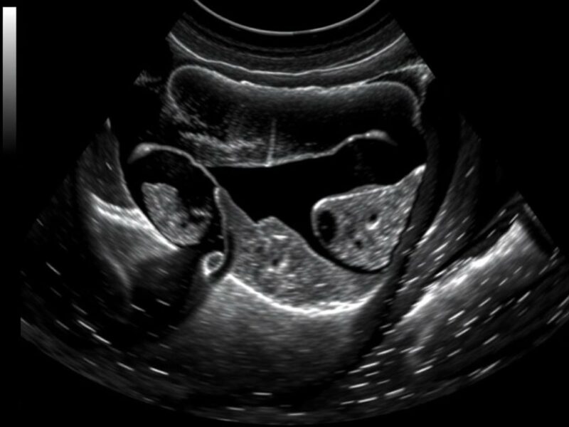 Befundung einer Abdomen-Sonographie beim Akutpatienten. Órganos clave y hallazgos frecuentes en el paciente agudo